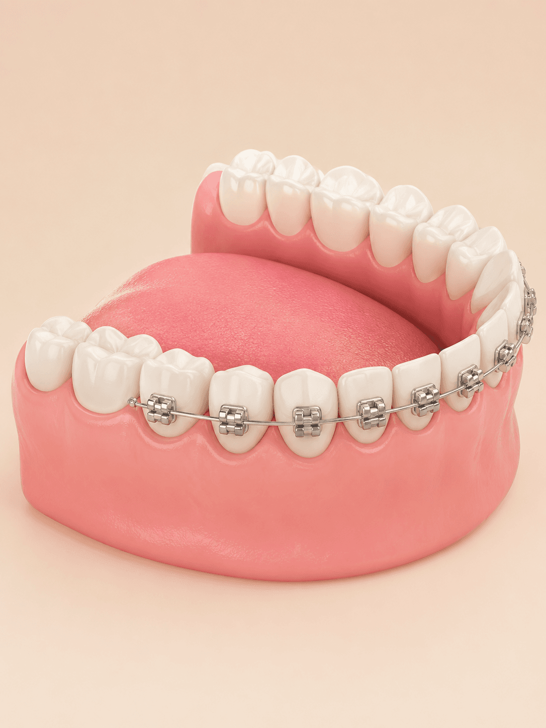 Braces