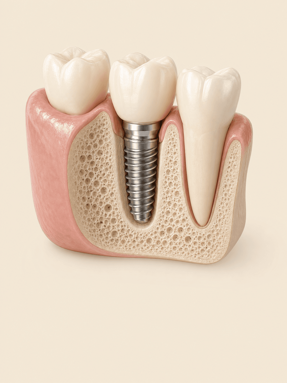 Implant Dentistry