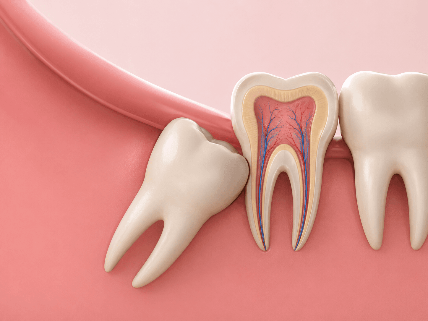 Impacted Wisdom Tooth