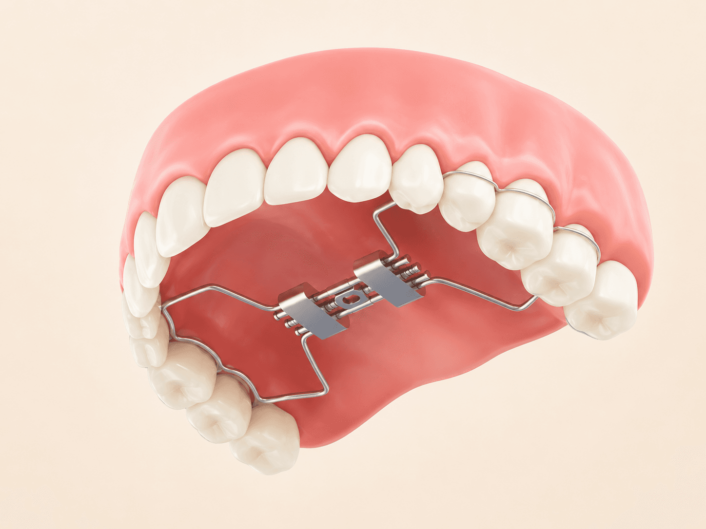 Palate Expanders