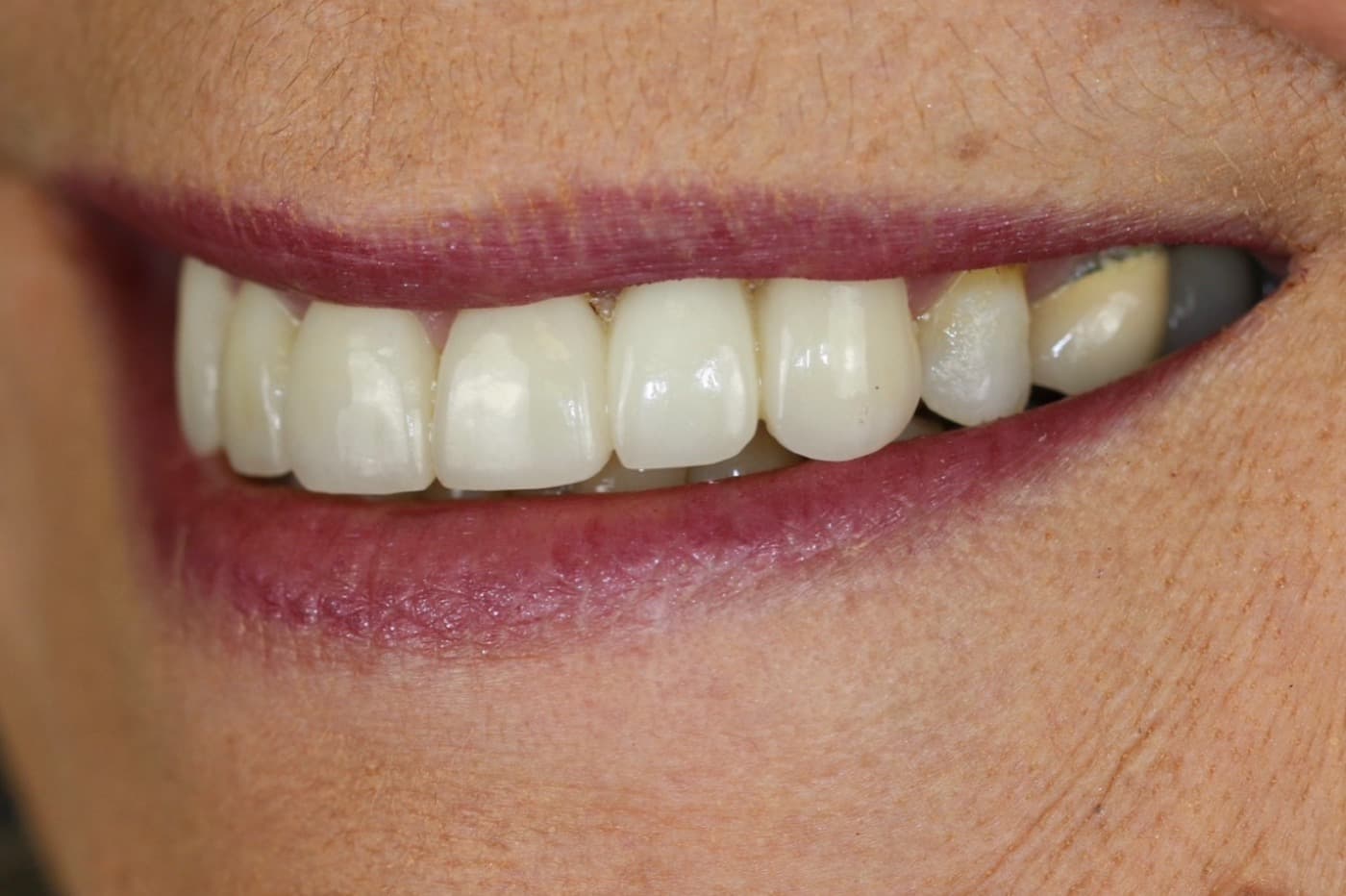 After — smile transformation 1