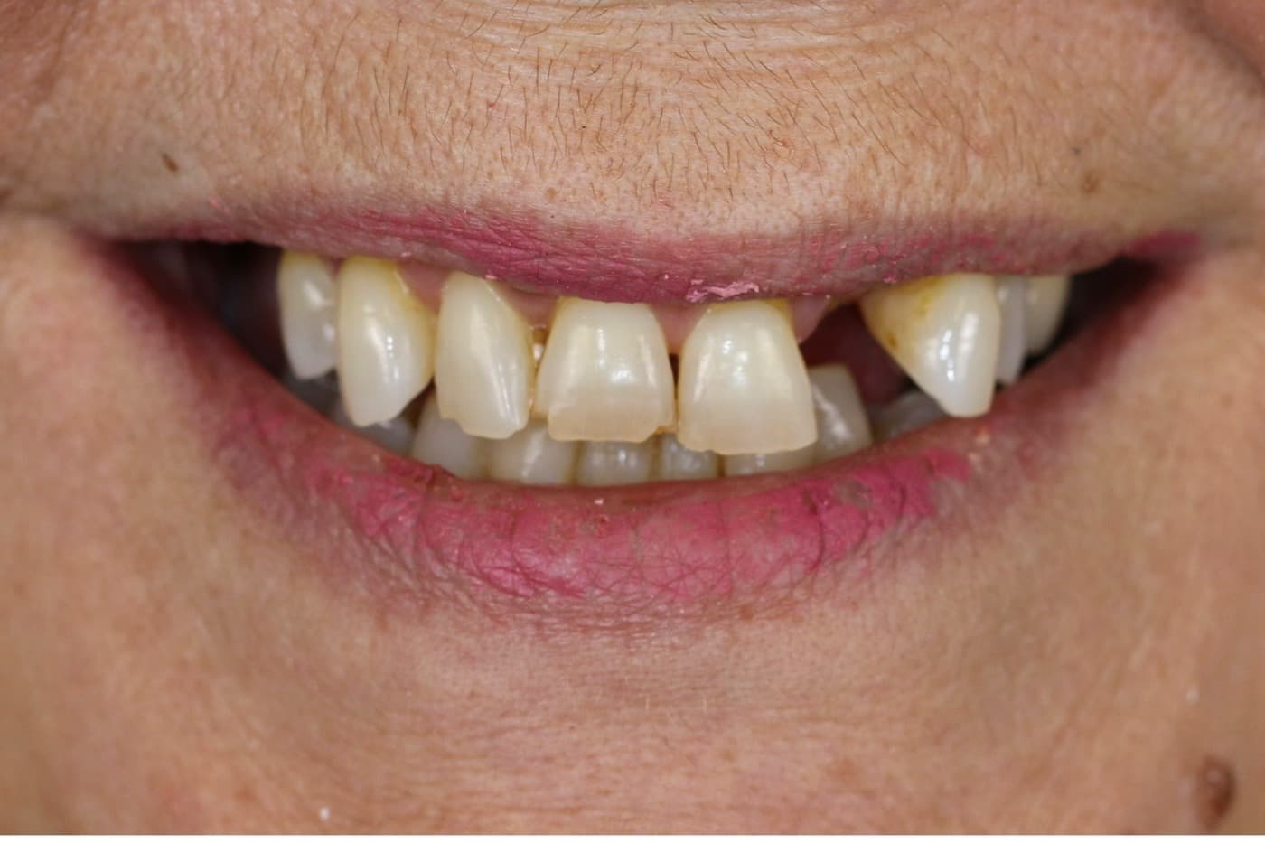 Before — smile transformation 1