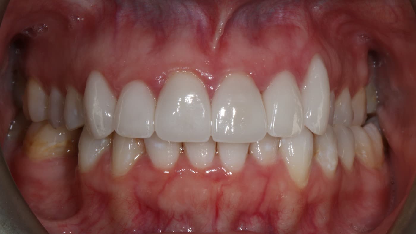 After — smile transformation 2