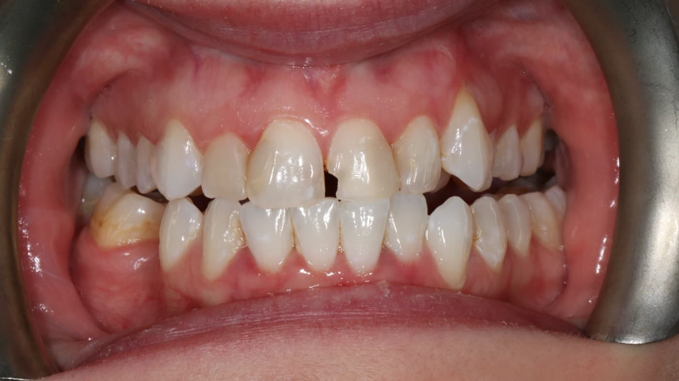 Before — smile transformation 2