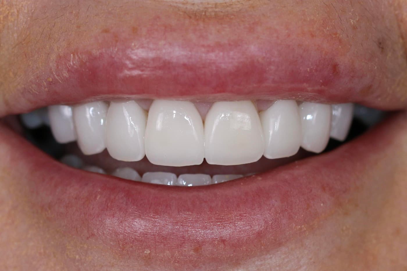 After — smile transformation 3