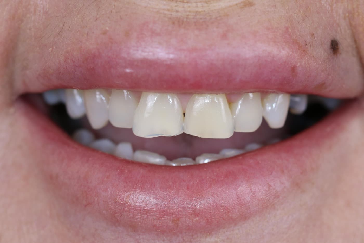 Before — smile transformation 3