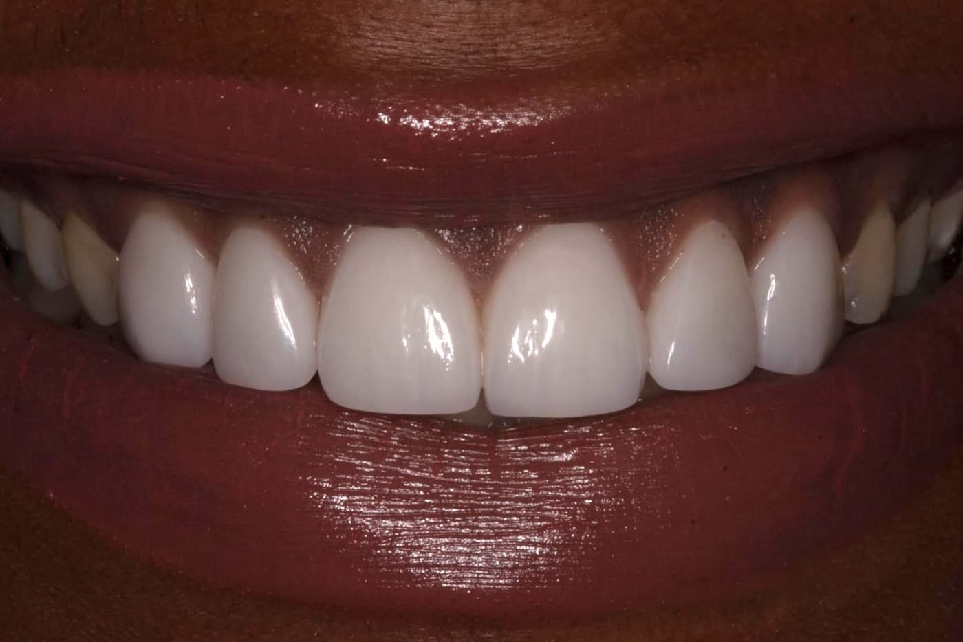 After — smile transformation 4