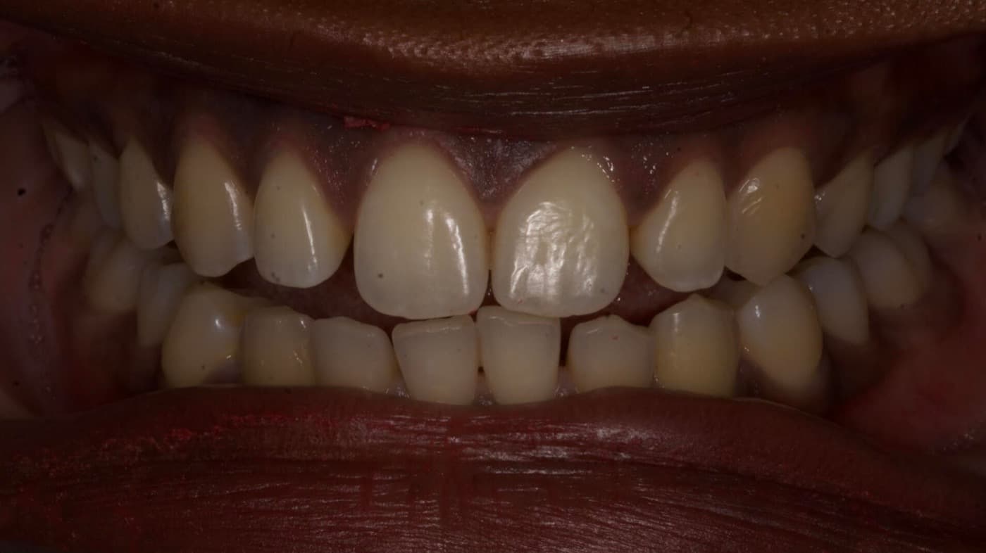 Before — smile transformation 4