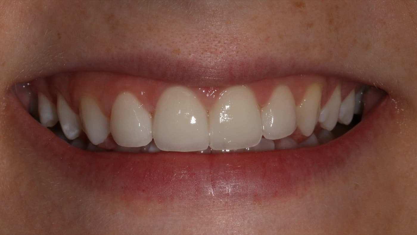 After — smile transformation 5