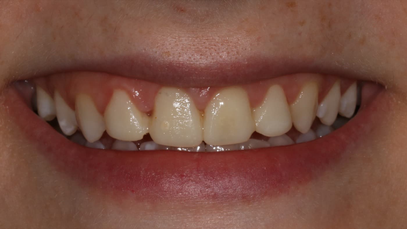 Before — smile transformation 5