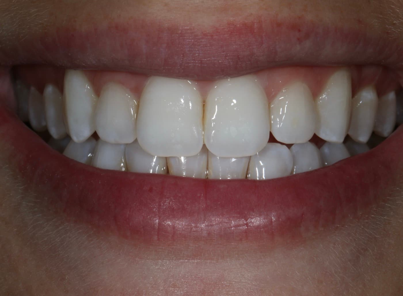 After — smile transformation 6