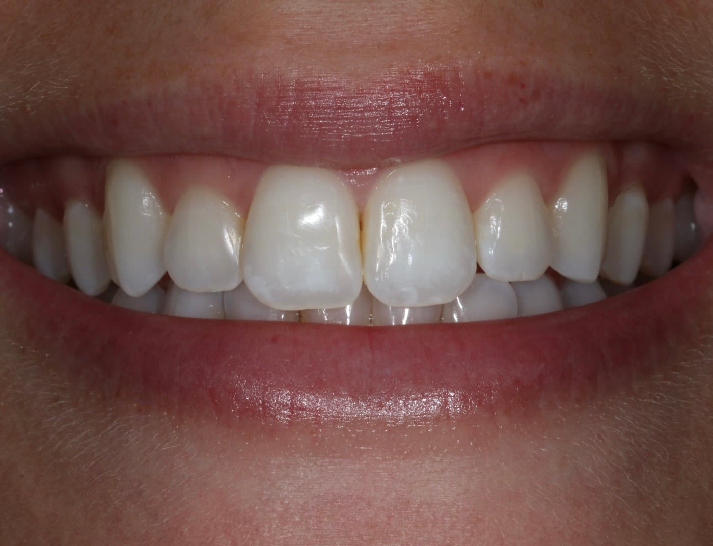 Before — smile transformation 6