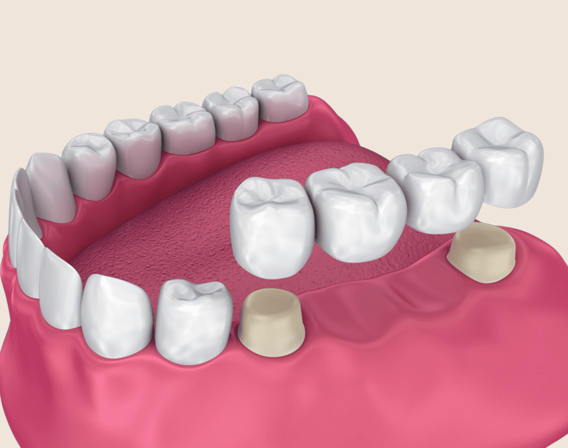 Dental Bridges