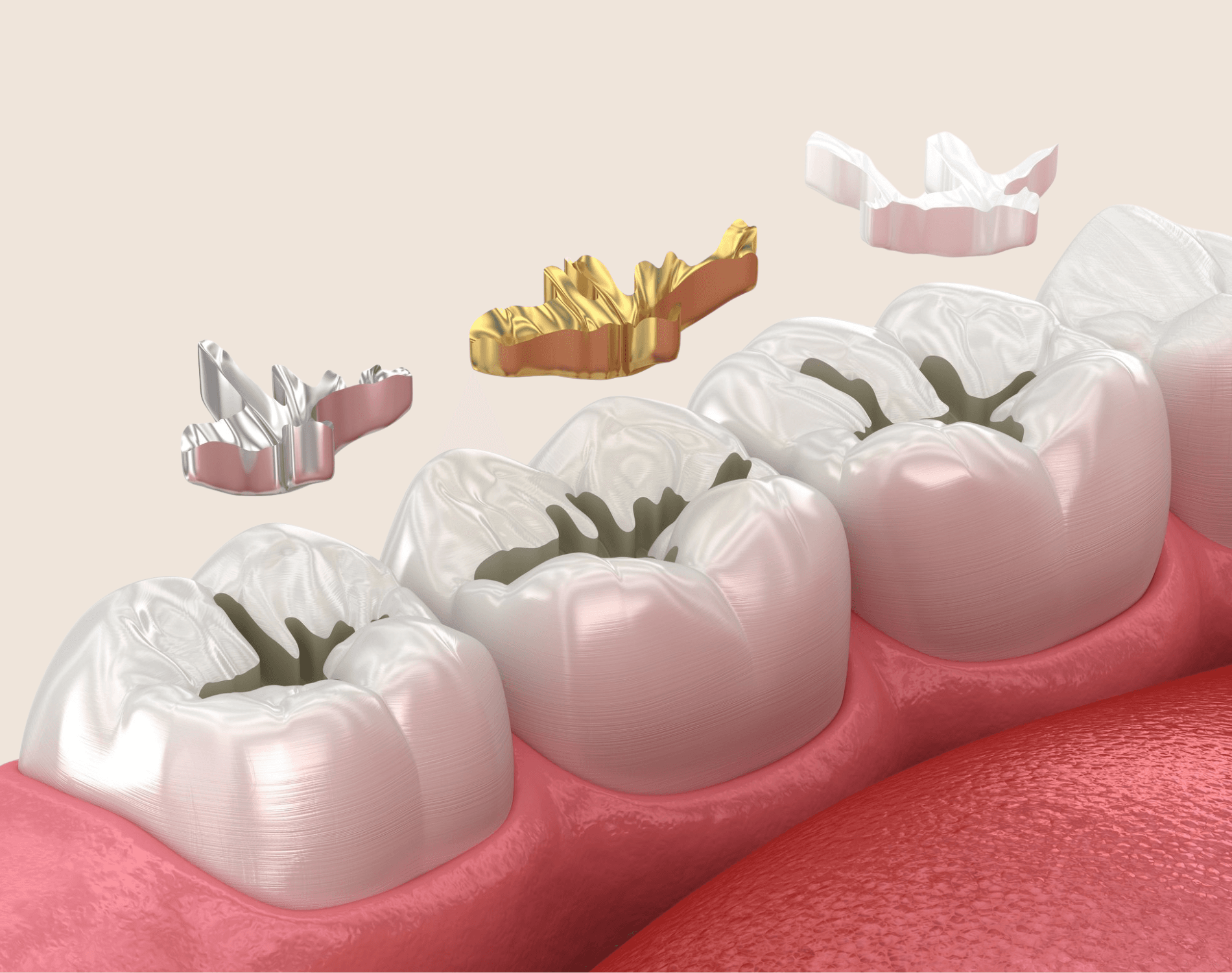 Dental Fillings