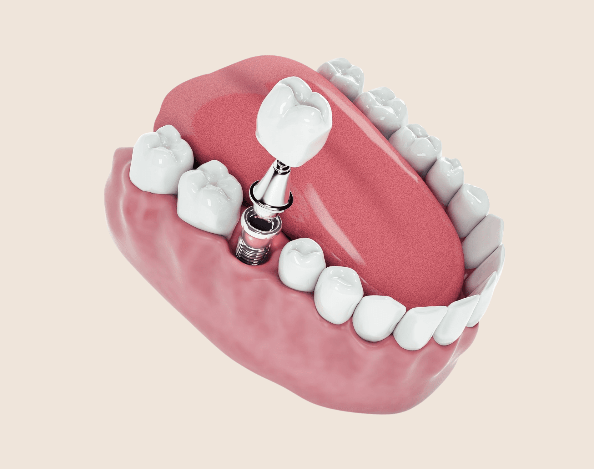 Dental Implants