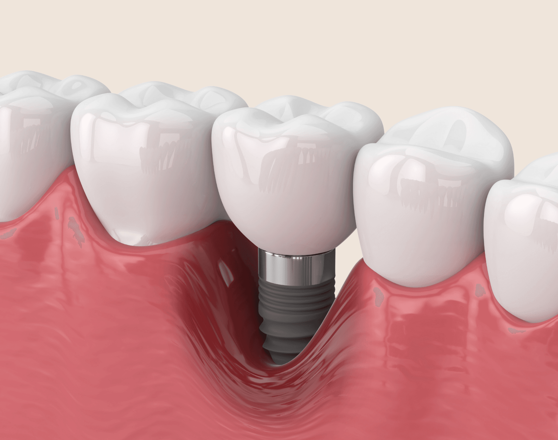 Guided Implant Surgery