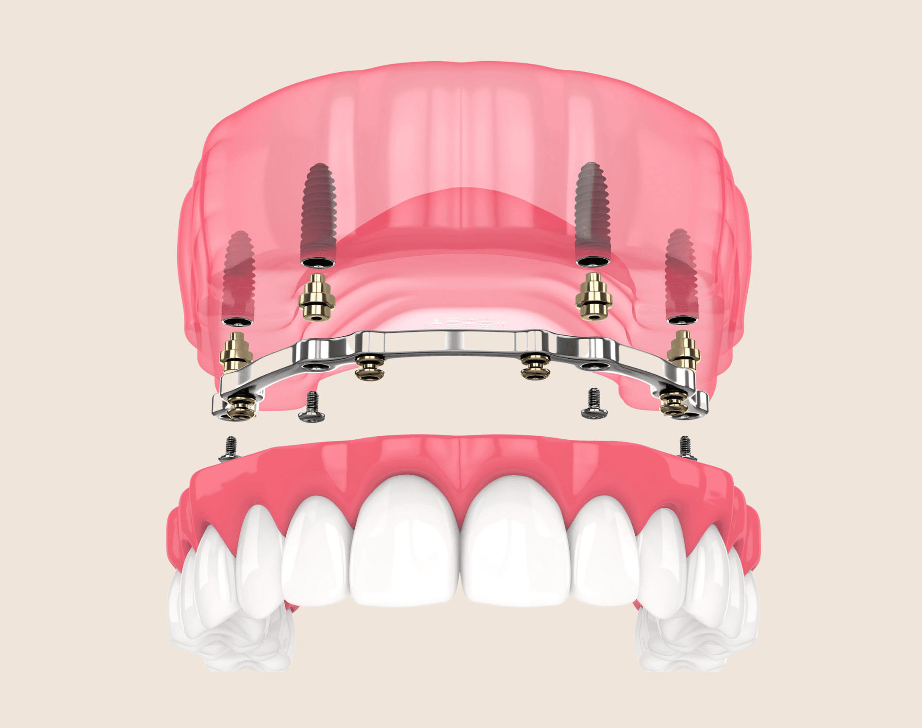 Locator or Bar Attachment Dentures