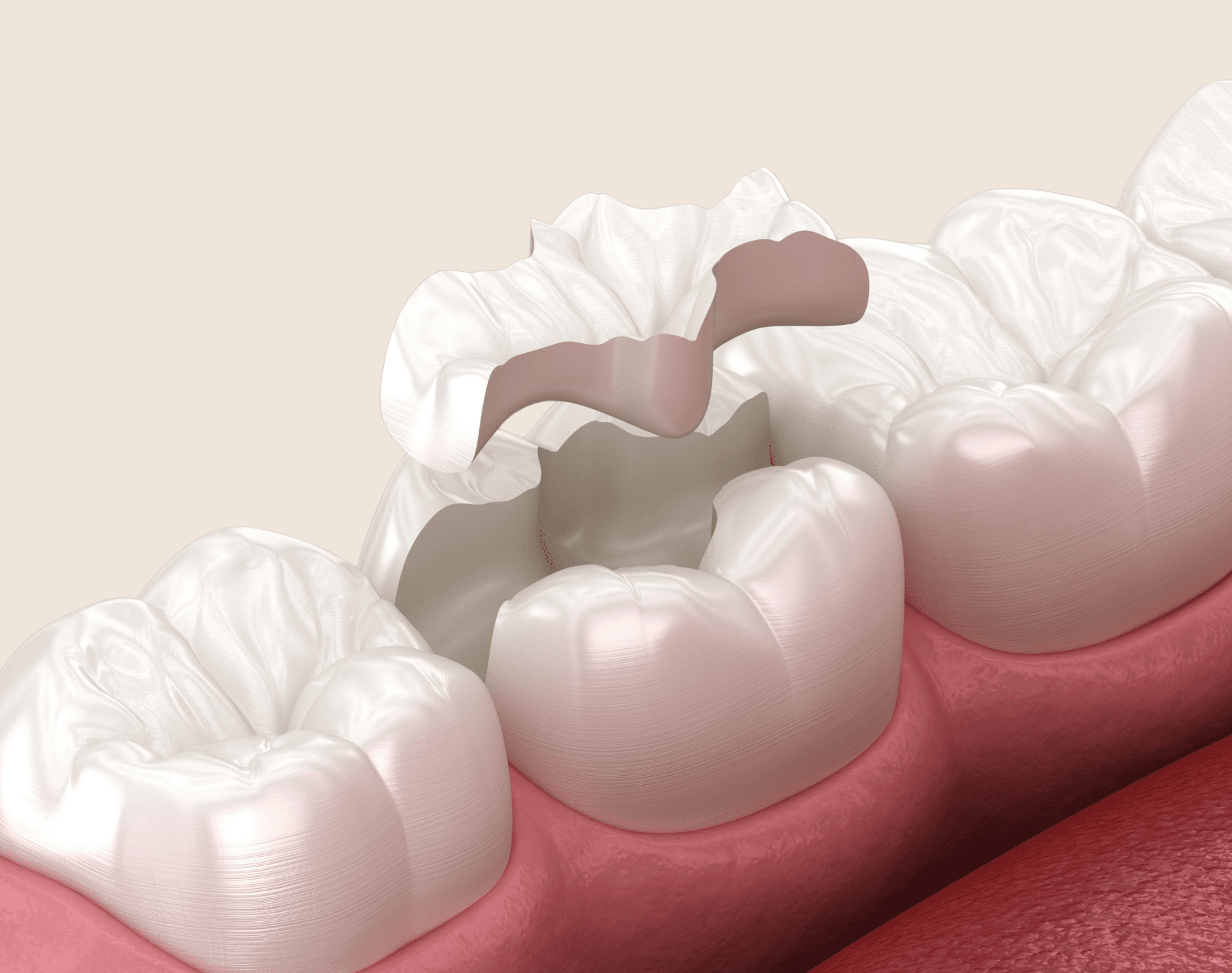 Lost or Loose Fillings