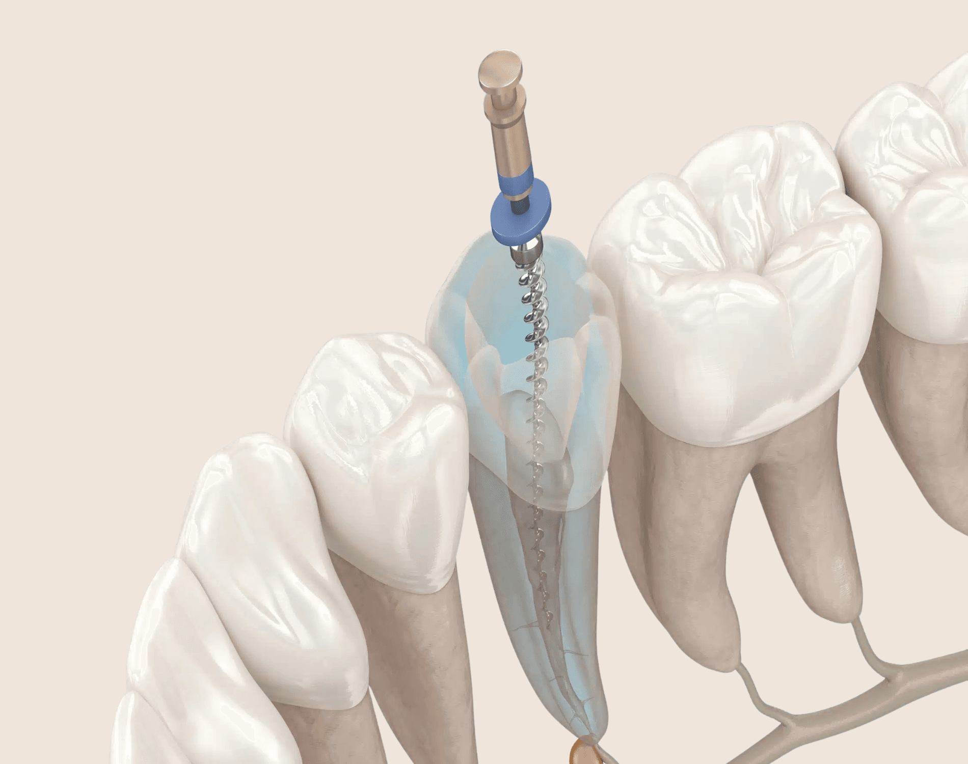 Root Canal Therapy