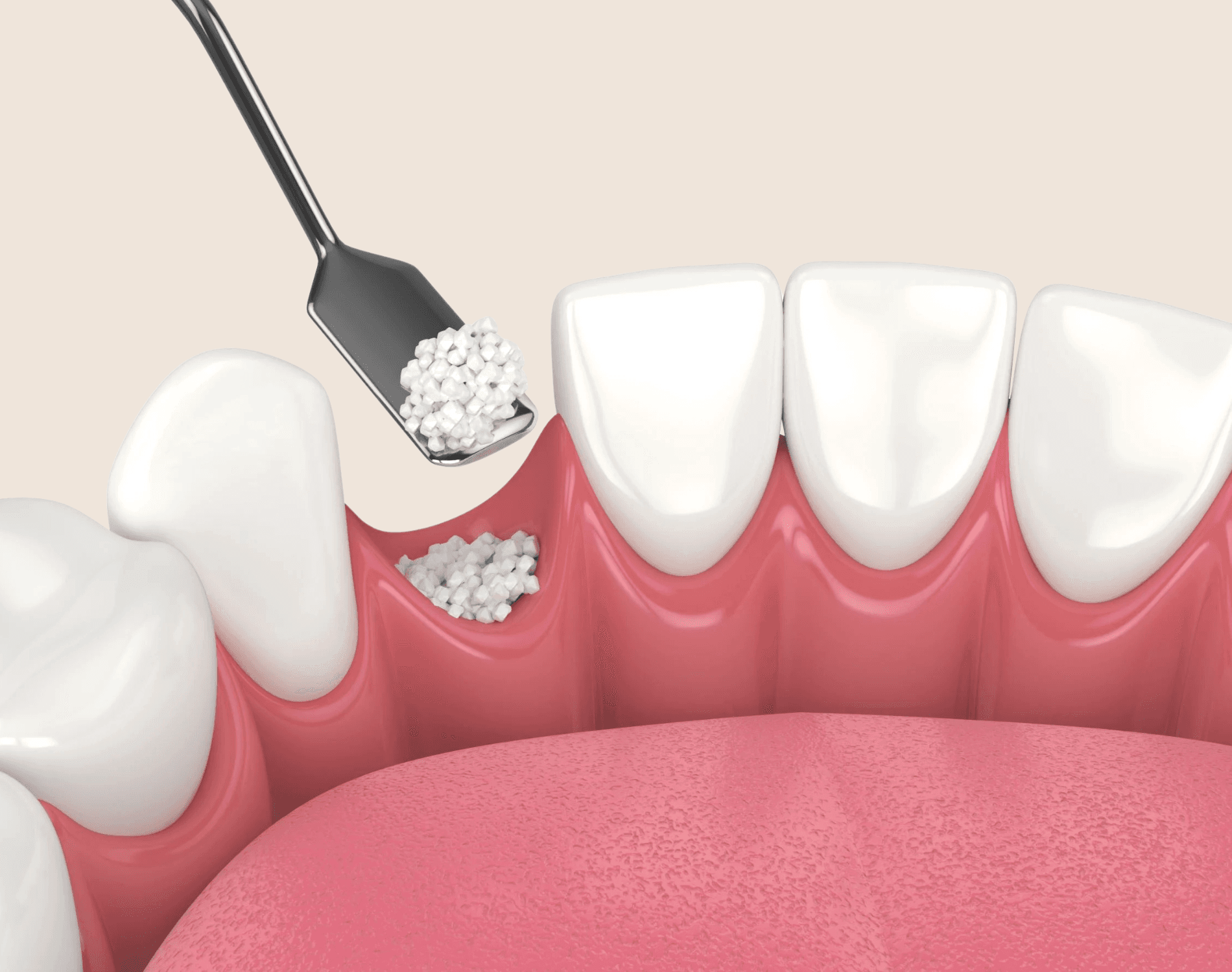 Socket Bone Graft
