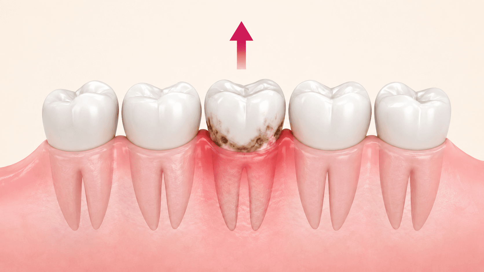 Wisdom Tooth Extraction